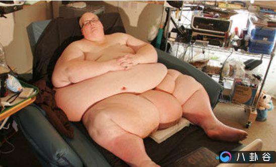 世界上最胖的人 因减掉500斤肉导致皮肤下垂严重
